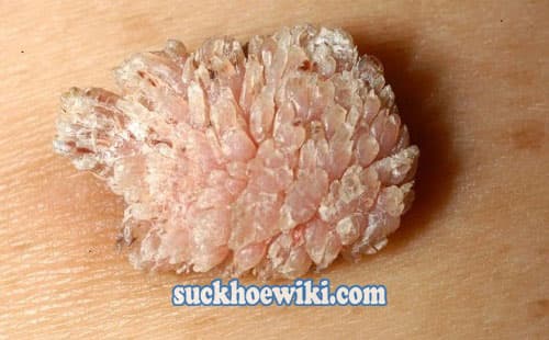 Dấu hiệu nhận biết sùi mào gà ở nam giới