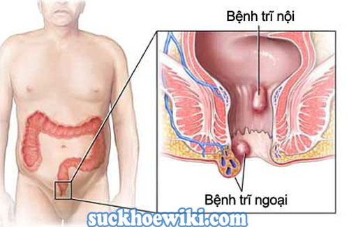 Mức độ bệnh trĩ.