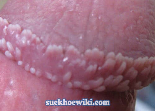 Nguyên nhân gây ra bệnh sùi mào gà ở nam giới