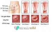 9 Dấu hiệu ung thư cổ tử cung giai đoạn đầu thường gặp