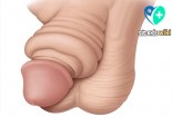 Bao quy đầu bị sưng, ngứa, đỏ là bệnh gì?
