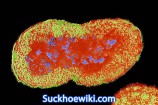 Bệnh lậu để lâu có sao không? Điều trị lậu bao lâu thì khỏi?