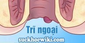 Bệnh trĩ ngoại là gì? Thông tin về bệnh trĩ ngoại