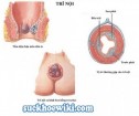Bệnh trĩ nội: Triệu chứng & cách chữa bệnh trĩ nội