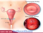 Viêm lộ tuyến cổ tử cung có thai được không?