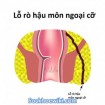 Bệnh rò hậu môn: Triệu chứng, nguyên nhân, chẩn đoán, điều trị