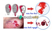 Máu báo có thai là gì? phân biệt với kinh nguyệt