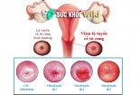 Phân biệt viêm lộ tuyến cổ tử cung độ 3 với độ 1, 2, 4