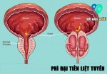 Bệnh phì đại tiền liệt tuyến và cách điều trị