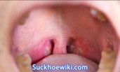 Bệnh lậu ở miệng: Nguyên nhân, triệu chứng và cách chữa