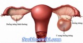 U nang buồng trứng triệu chứng cách điều trị tốt nhất 2021