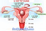 U xơ cổ tử cung nguyên nhân triệu chứng cách chữa hiệu quả nhất 2020