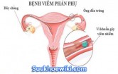 Viêm phần phụ là gì? Nguyên nhân triệu chứng cách điều trị hiệu quả