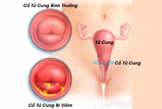 Viêm cổ tử cung sau sinh nguyên nhân cách điều trị