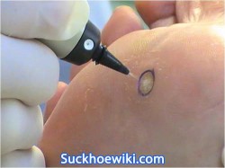 Đốt sùi mào gà bao lâu thì khỏi và quan hệ được? Suckhoewiki