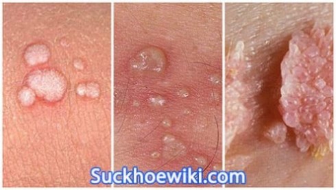 12 cách chữa bệnh sùi mào gà tại nhà bằng mẹo dân gian