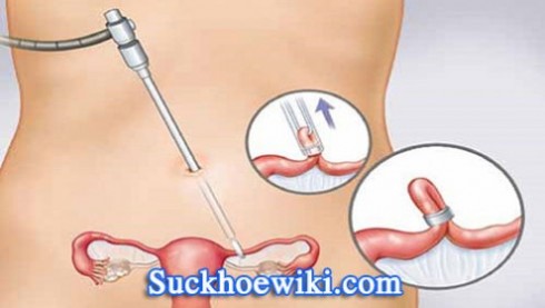 Thắt ống dẫn trứng là gì, chi phí khoảng bao nhiêu?
